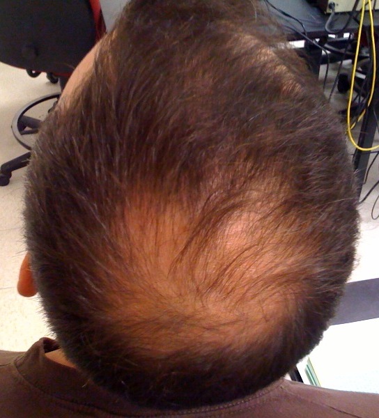 Androgenní alopecie předznamenává nevratné vypadávání vlasů. FOTO: Welshsk / Creative Commons / CC BY 3.0