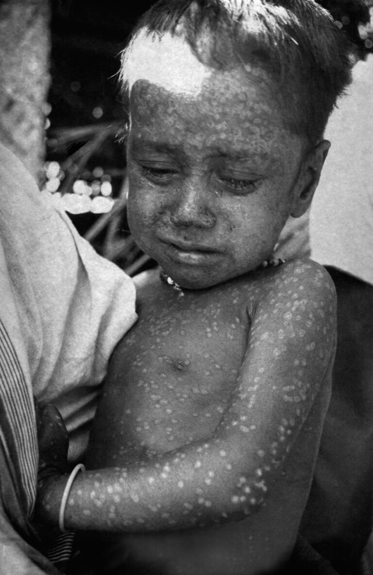 Tříletý chlapec z Bangladéše byl poslední osobou, která se nakazila přirozeně se vyskytujícím virem pravých neštovic, rok 1975. FOTO: CDC/ World Health Organization Stanley O. Foster M.D., M.P.H. / Creative Commons / volné dílo