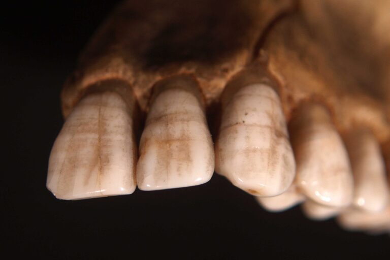 Zuby vypovídají o stravě dotyčného. FOTO: Otis Historical Archives Nat'l Museum of Health & Medicine/Creative Commons/ CC BY 2.0