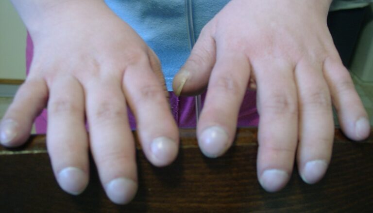 Onemocnění, kterým v ČR trpí asi 700 lidí, je často provázeno deformovanými a zvětšenými prsty. FOTO: Ann McGrath / Creative Commons / volné dílo