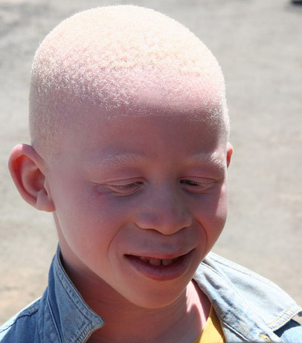 Albinismus se vyskytuje také v lidské populaci. Foto: Původní uploader byl Muntuwandi na anglické Wikipedii., CC BY-SA 3.0 , via Wikimedia Commons