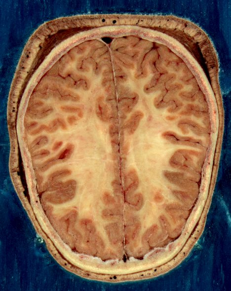 Kortikální záhyby a bílá hmota v horizontálním řezu hlavy. FOTO: National Library of Medicine / Creative Commons / volné dílo