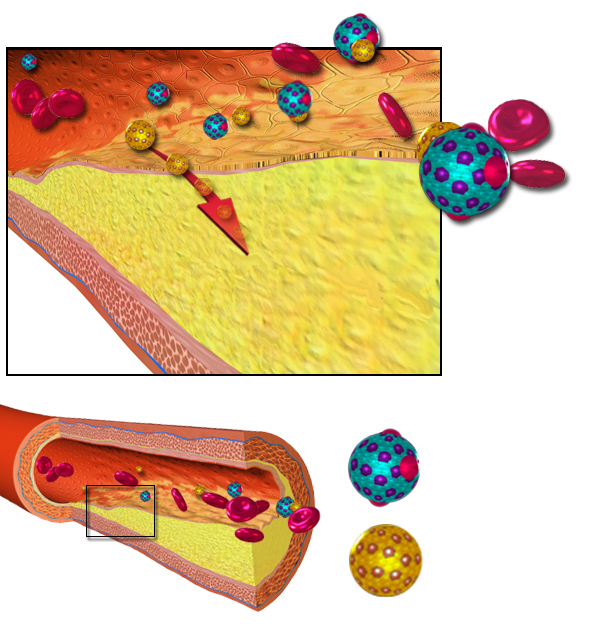 Ukládání cholesterolu snižuje průchodnost cév. FOTO: BruceBlaus / CC / CC BY 3.0